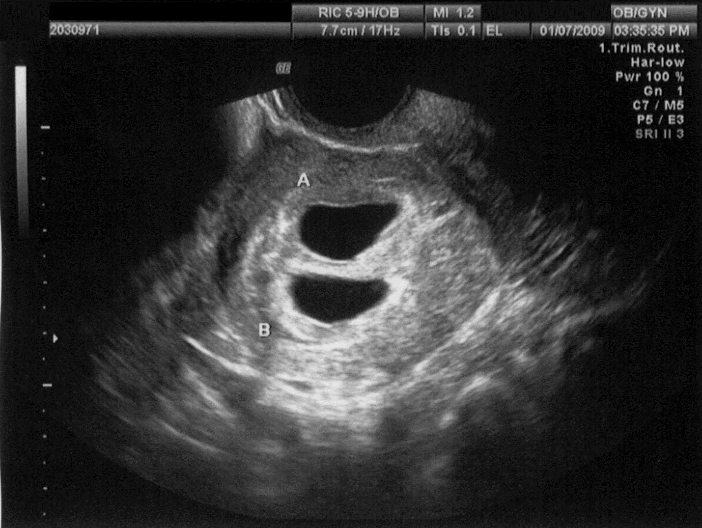 Cervical-cancer-diagnosis-vaginal-ultrasound