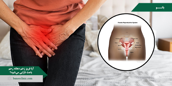 آیا فریز زخم دهانه رحم باعث نازایی میشود