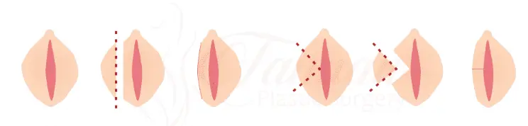 Vaginal-cosmetic-surgery-stitches