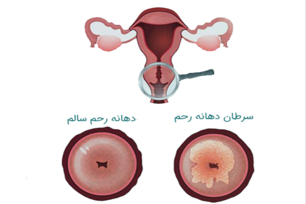 درمان قطعی سرطان دهانه رحم
