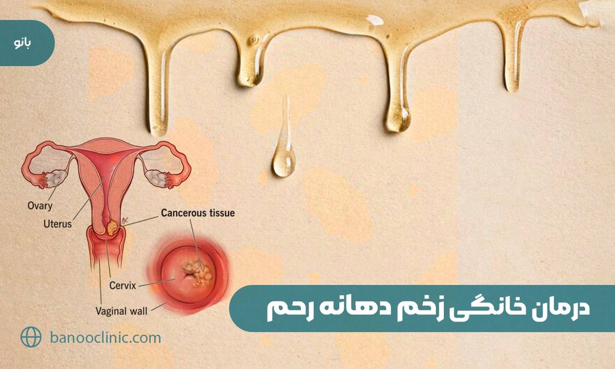 درمان خانگی زخم دهانه رحم  